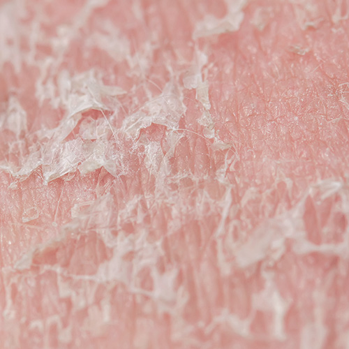 敏感性皮肤可能会导致部分皮肤干燥脱皮