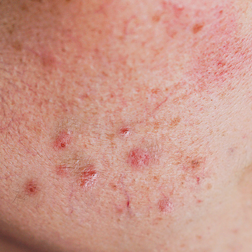 部分由于敏感性皮肤引起的伤痕可能会很难恢复但是ogana能治疗