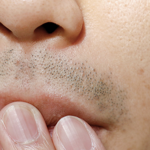 Close-up of facial hair on upper lip causing discomfort in wearing short clothes