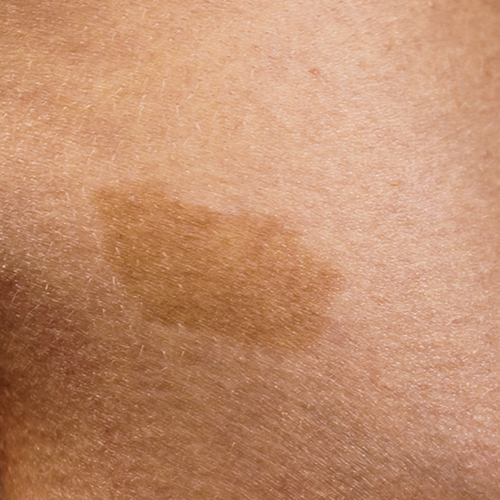 Detailed close-up of a cafe au lait macule on skin showing light brown pigmentation.