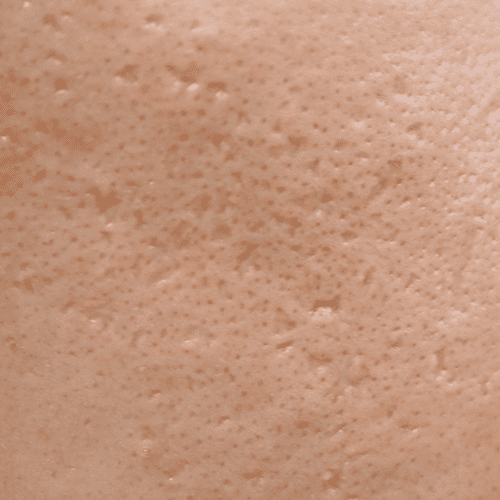 Close-up of skin with visible acne scars and enlarged pores