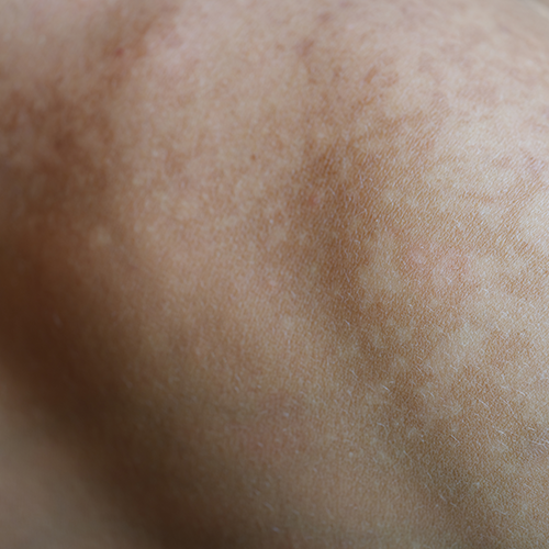 Close-up view of skin with Becker's nevus showing pigmentation and texture differences