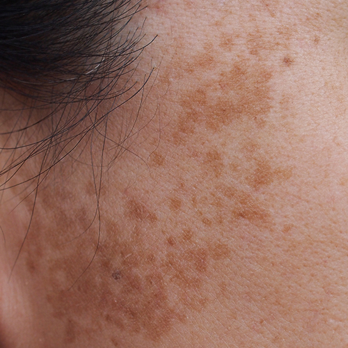 Detailed view of Agminated Lentiginous Nevus on facial skin