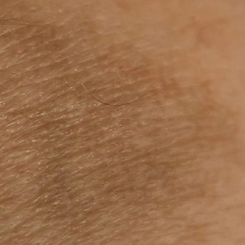 Close-up view of Nevus of Ota on skin - hyperpigmented blue or gray lesions common around the eye area.