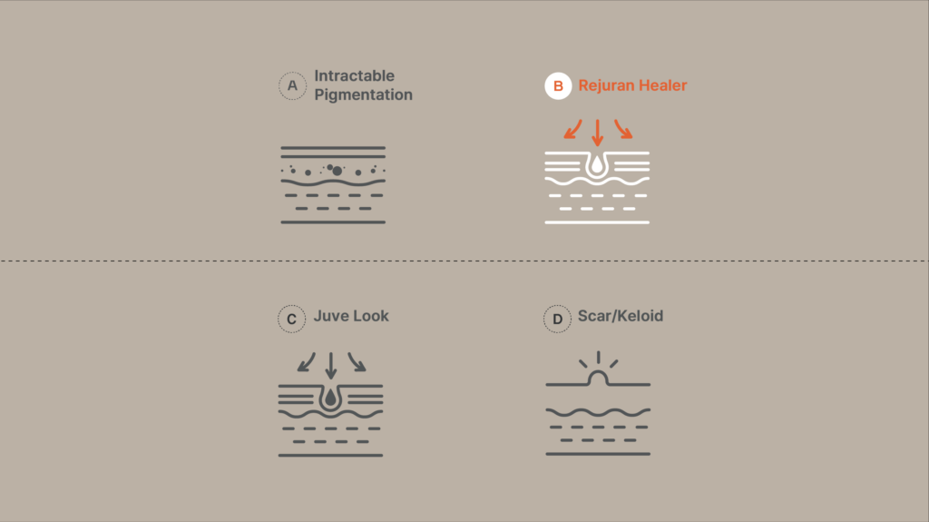 Infographic illustrating various skin treatments: A for Intractable Pigmentation, B for Rejuran Healer, C for Juve Look, and D for Scar/Keloid