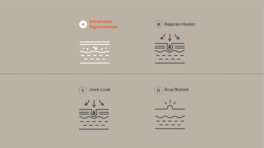 Illustrated guide to various skin treatments including Intractable Pigmentation, Rejuran Healer, Juve Look, and Scar/Keloid treatments